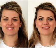 Before & After